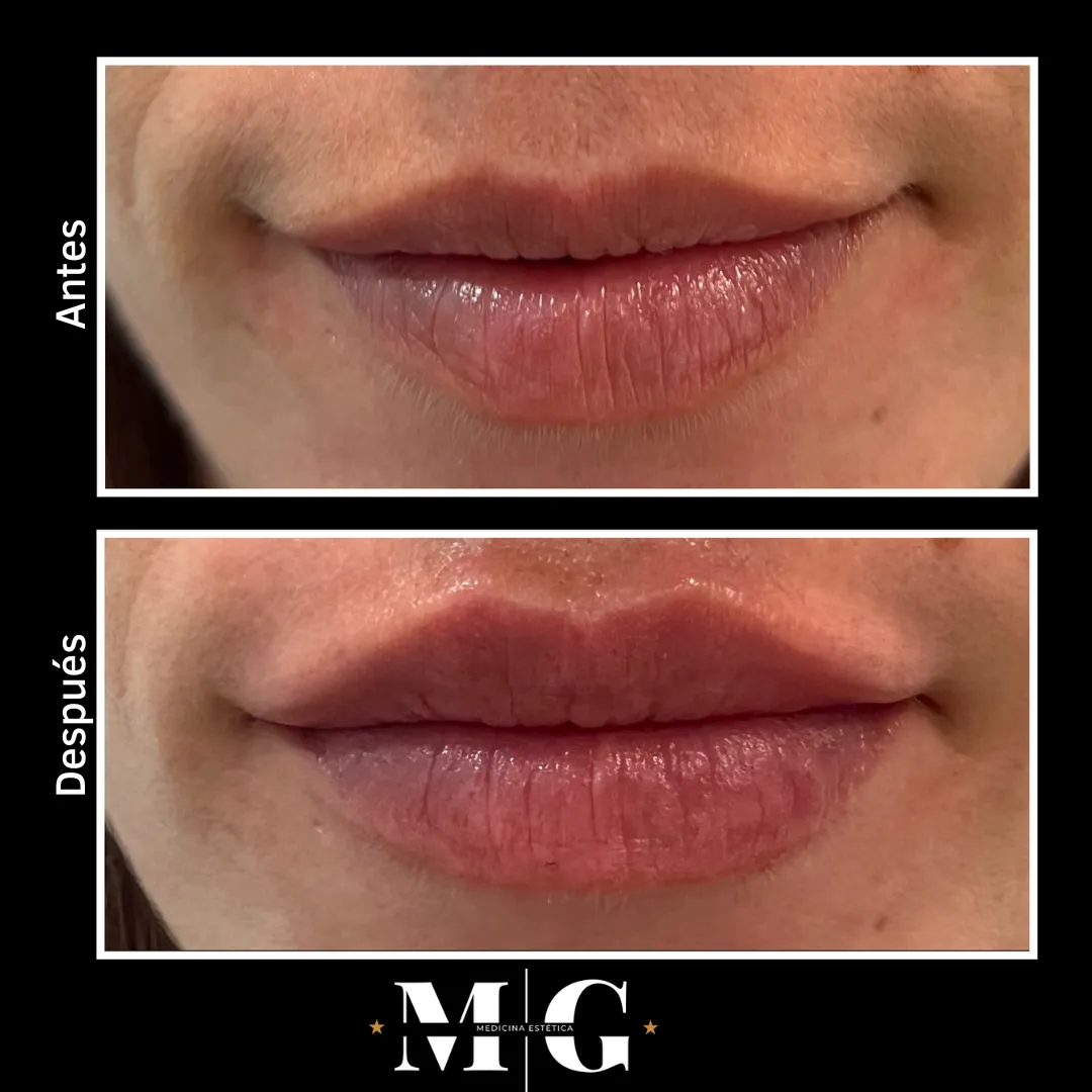 Antes y después relleno de labios Barcelona.
