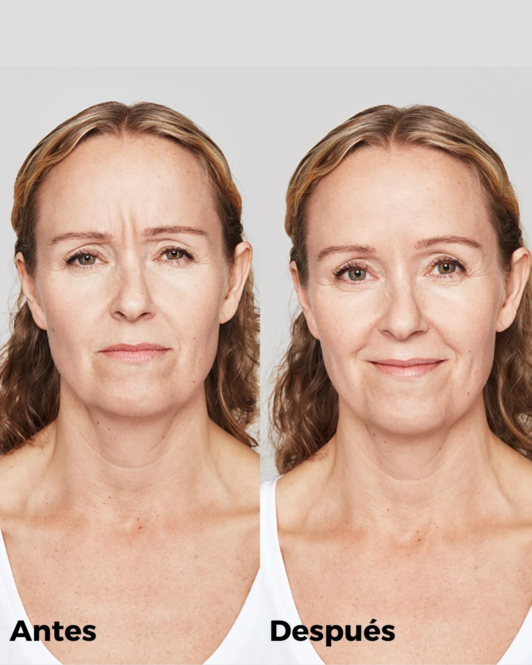 Antes y después de eliminar las arrugas de expresión.