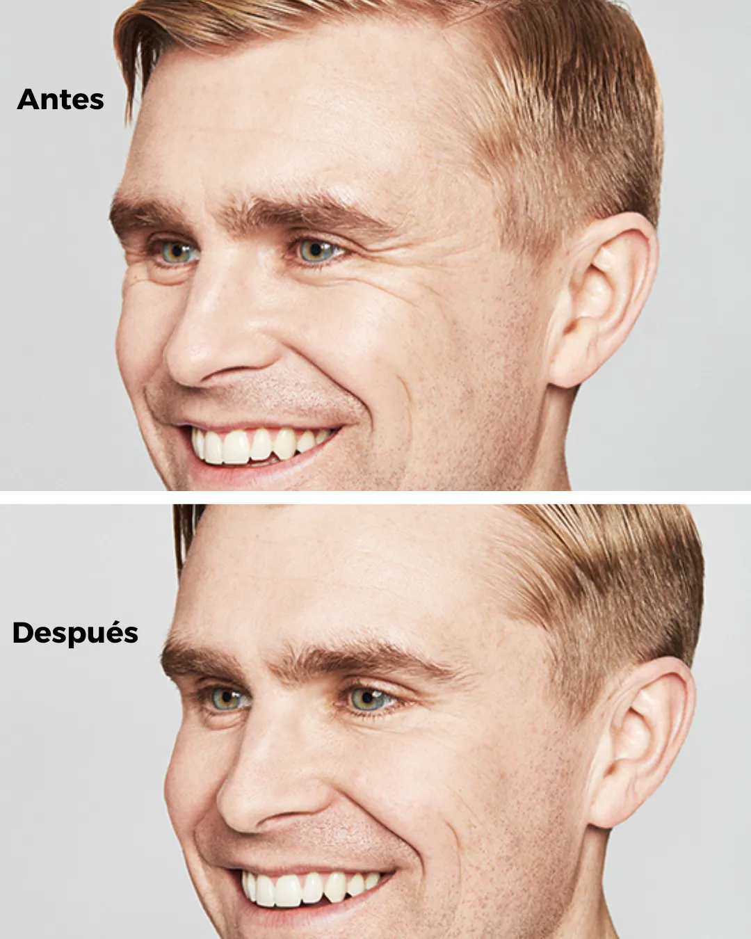 Antes y después de eliminar las patas de gallo.