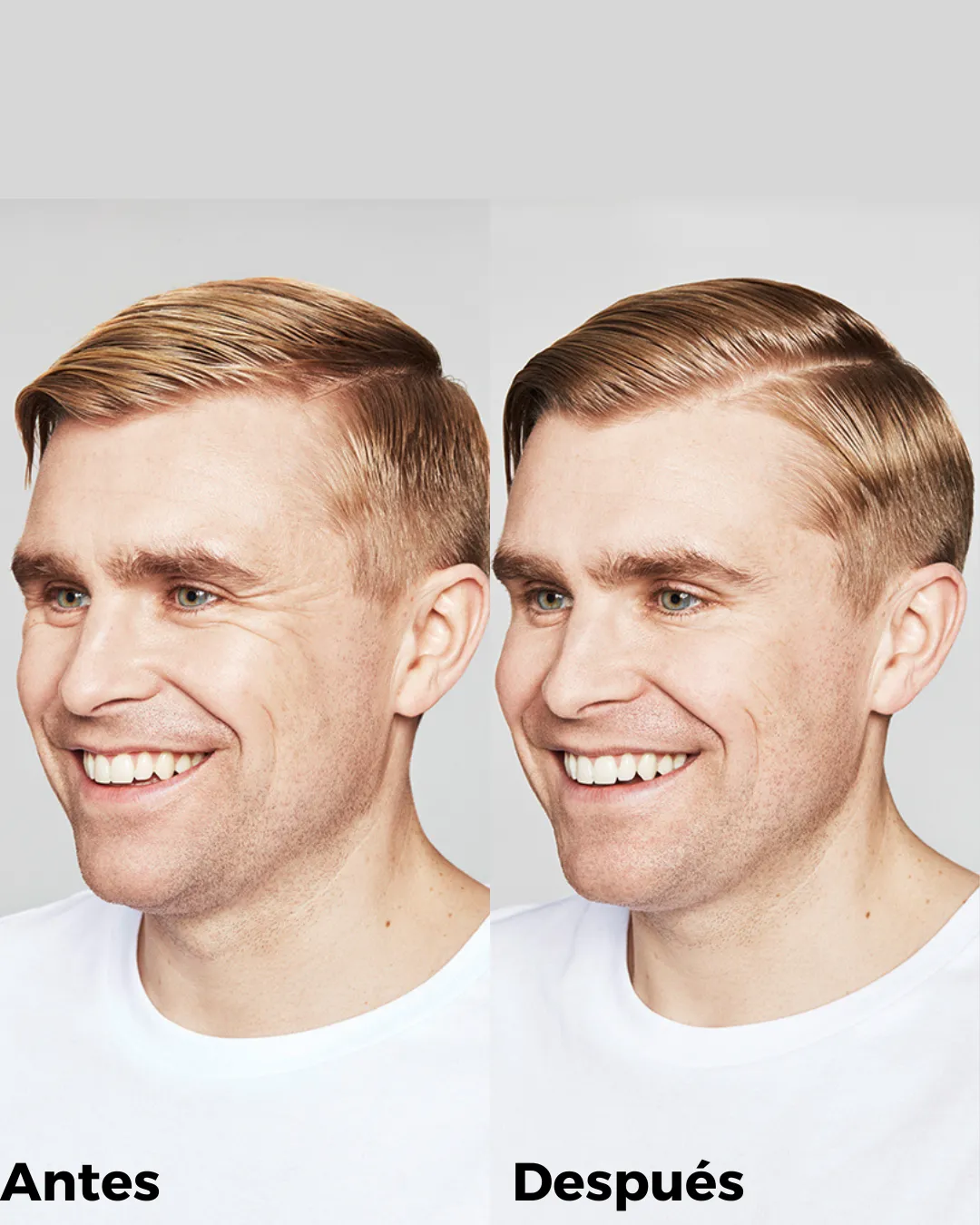 Antes y después de eliminar las arrugas de expresión.