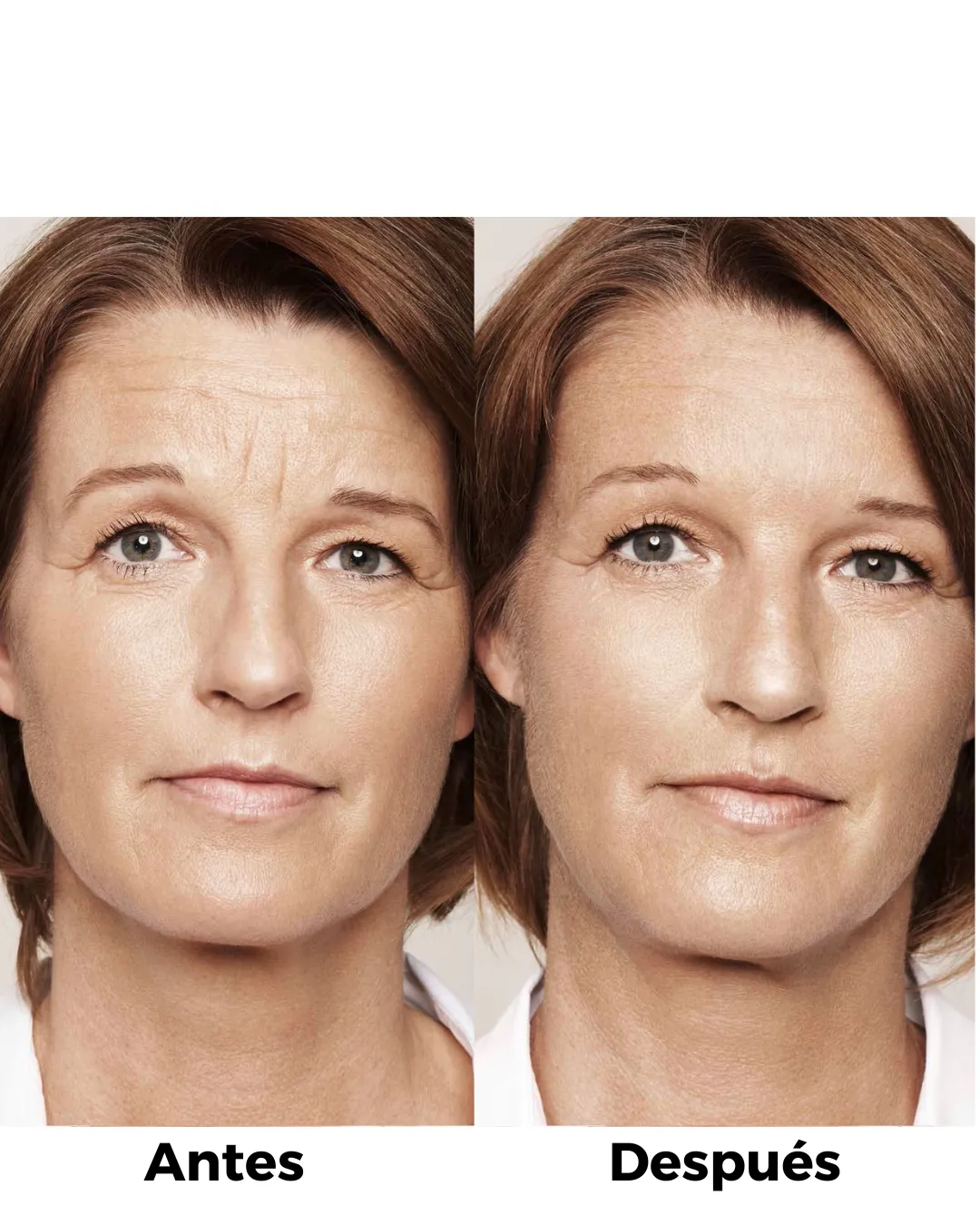 Antes y después de eliminar las arrugas de expresión.