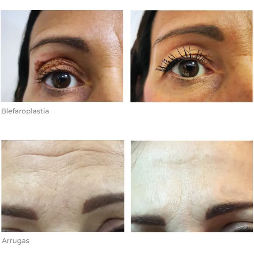 Antes y después blefaroplastia sin cirugía en Barcelona.