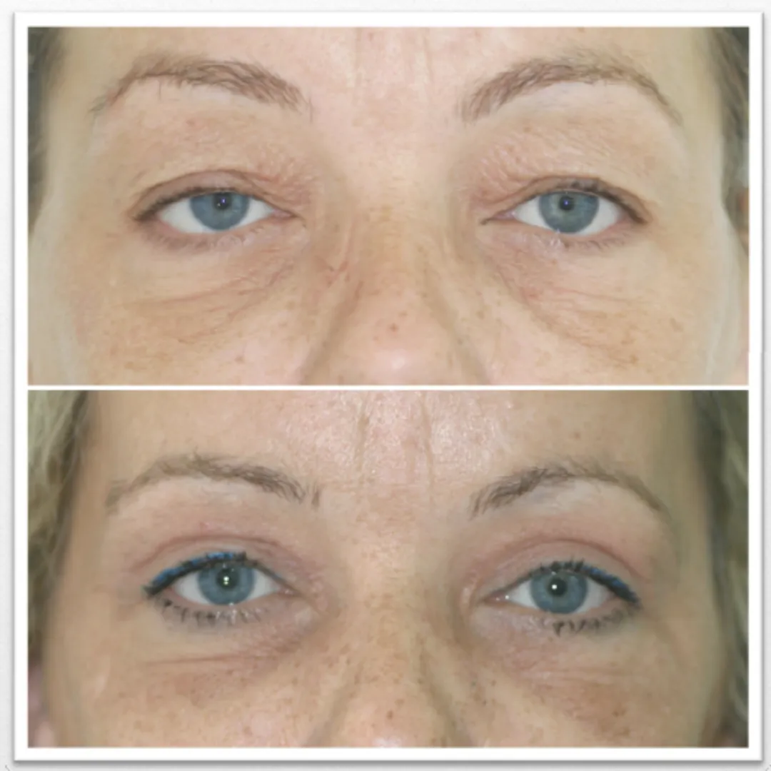 Antes y después blefaroplastia sin cirugía en Barcelona.