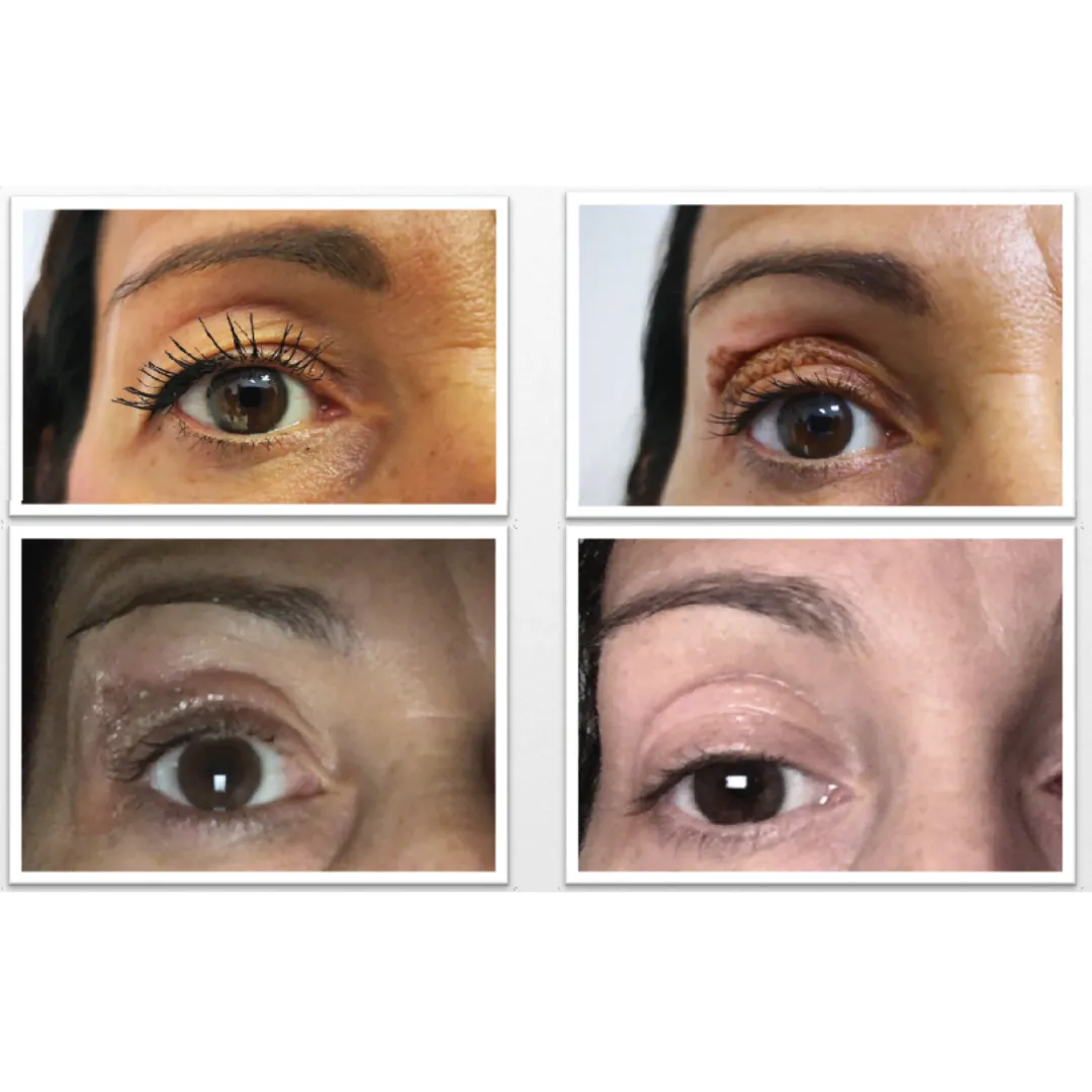 Antes y después blefaroplastia sin cirugía.