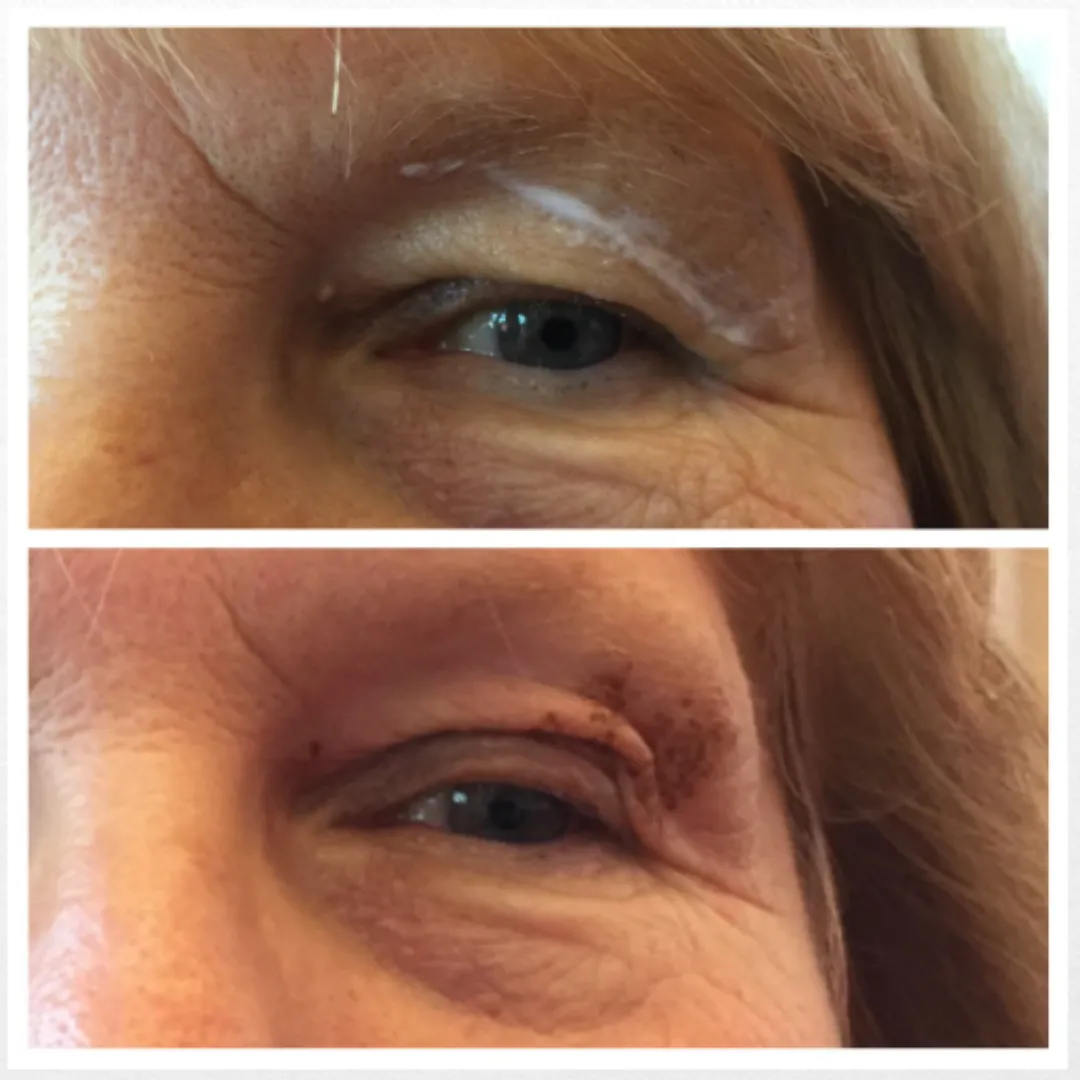 Antes y después blefaroplastia sin cirugía.