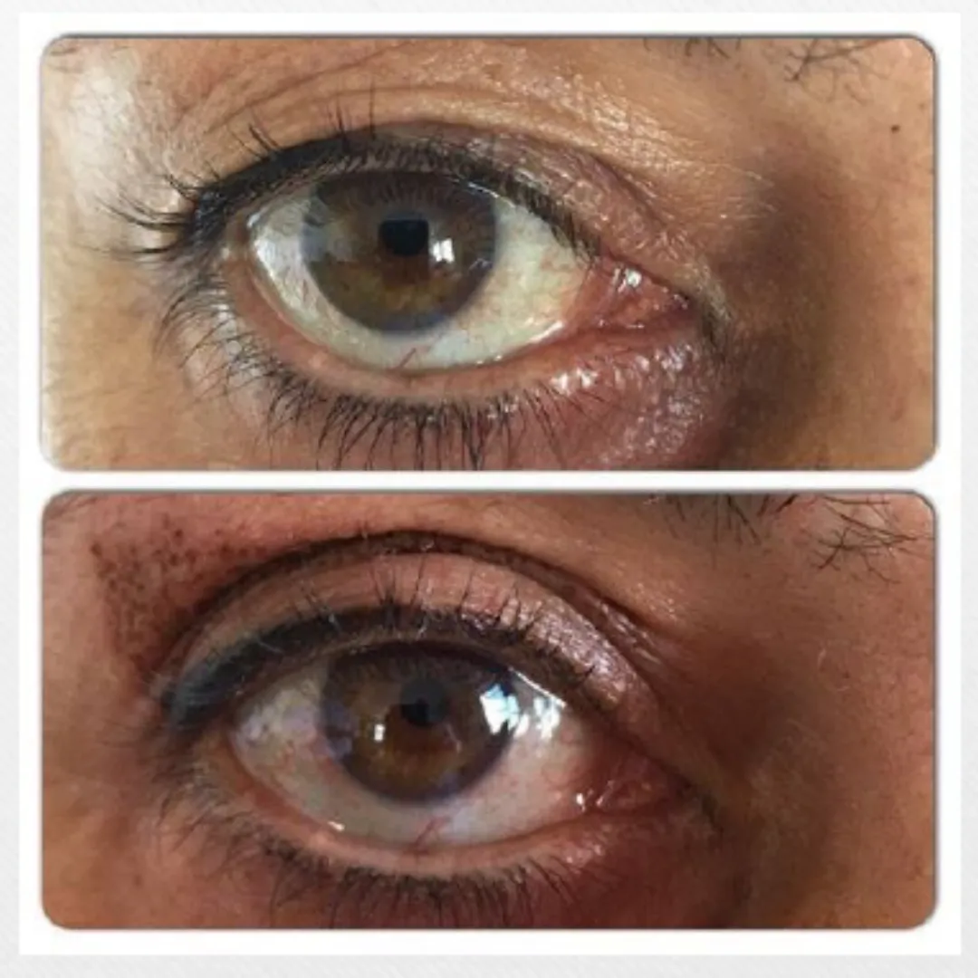 Antes y después blefaroplastia sin cirugía en Barcelona.