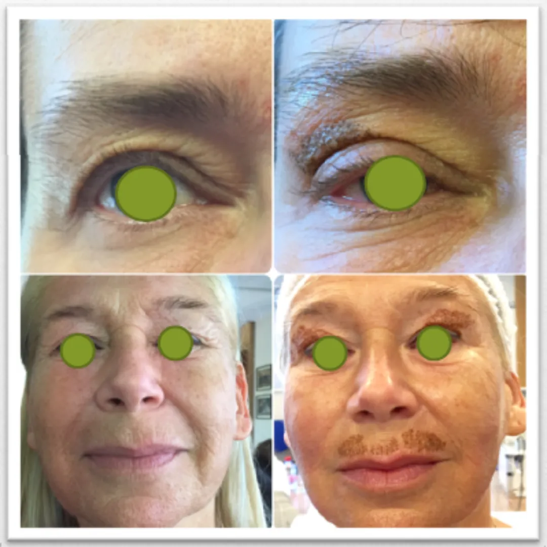 Antes y después blefaroplastia sin cirugía.