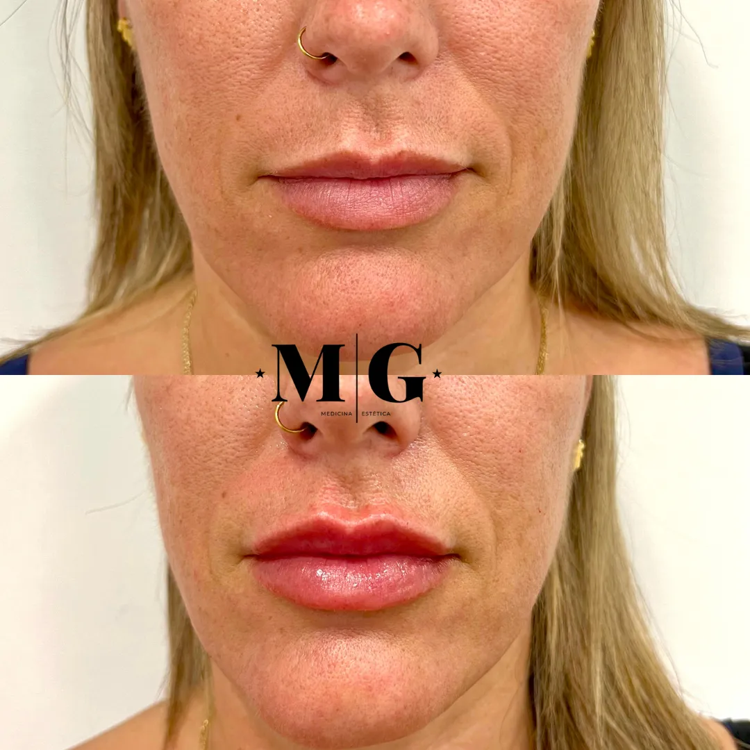 Antes y después relleno de labios con ácido hialurónico.