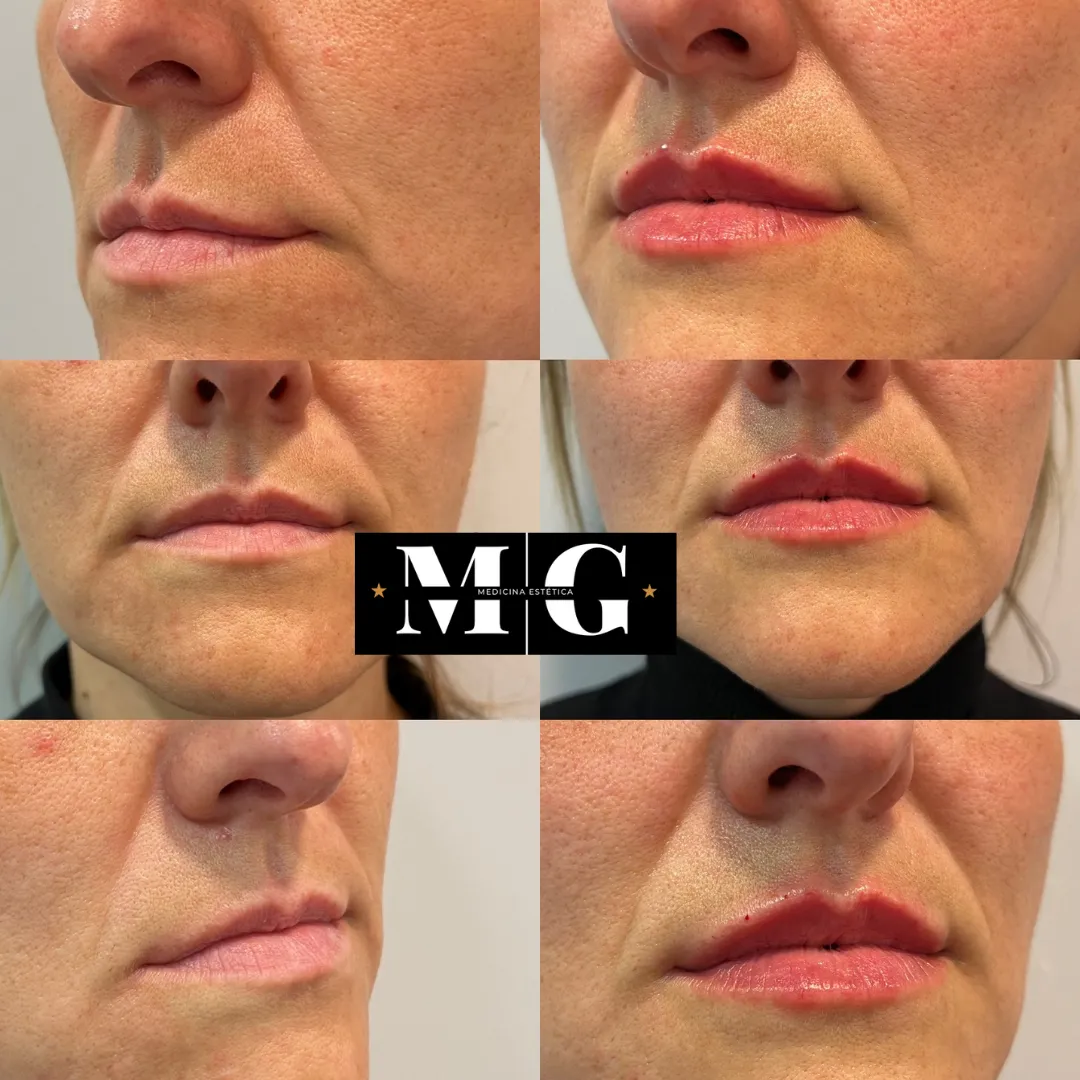 Antes y después del aumento de labios en Barcelona.