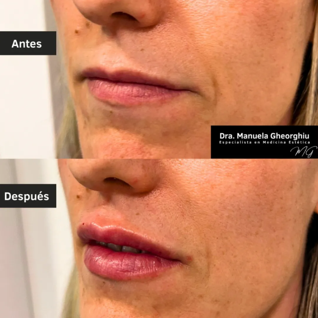 Antes y después tras seguir recomendaciones en aumento de labios con ácido hialurónico.