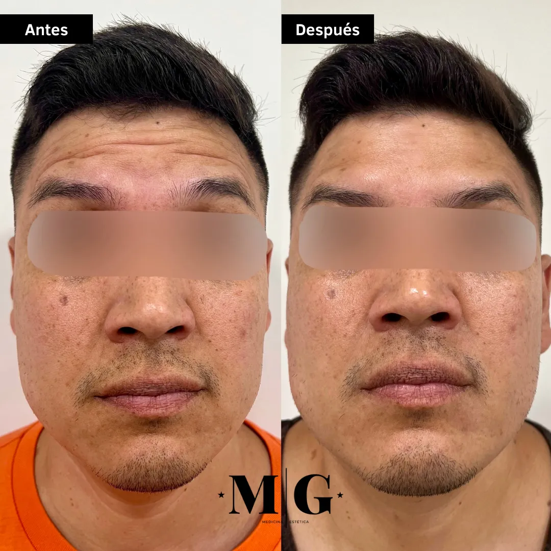 Antes y después de eliminar las arrugas de la frente en hombre.