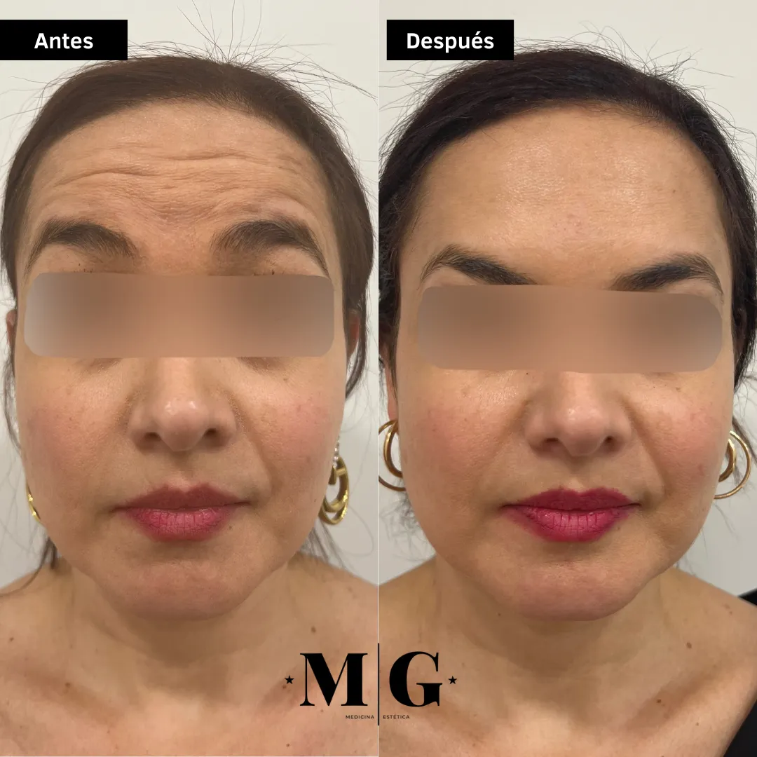 Antes y después de eliminar las arrugas de la frente.