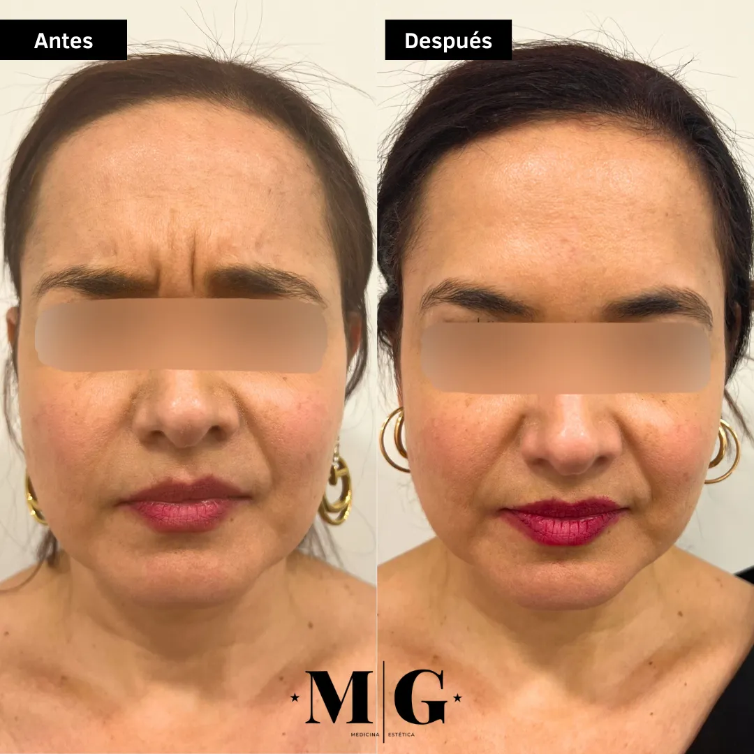 Antes y después de eliminar las arrugas del entrecejo.
