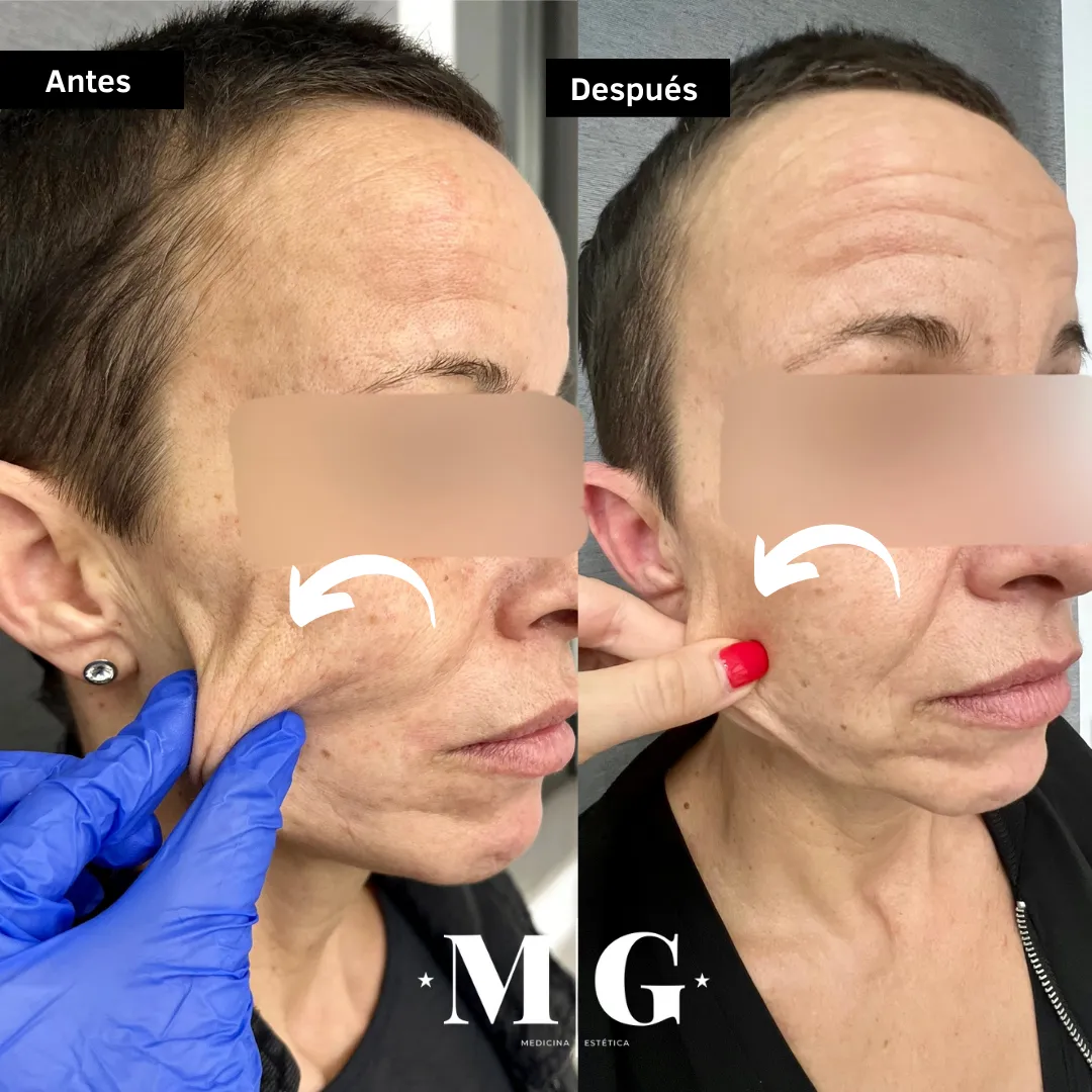 Sculptra cara antes y después.