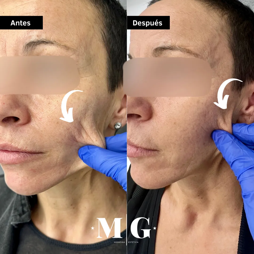 Sculptra cara antes y después.