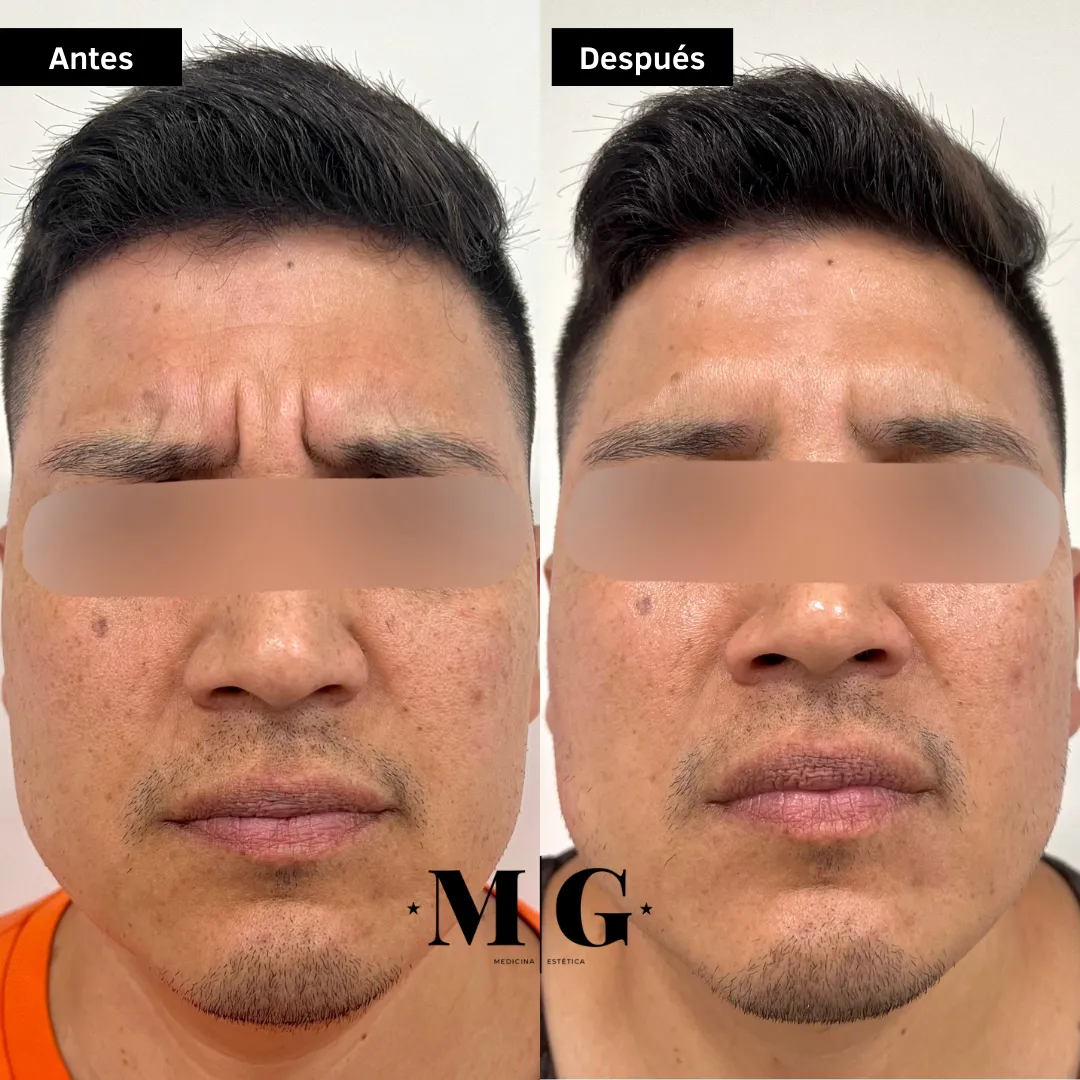 antes y después de eliminar las arrugas del entrecejo en hombre.
