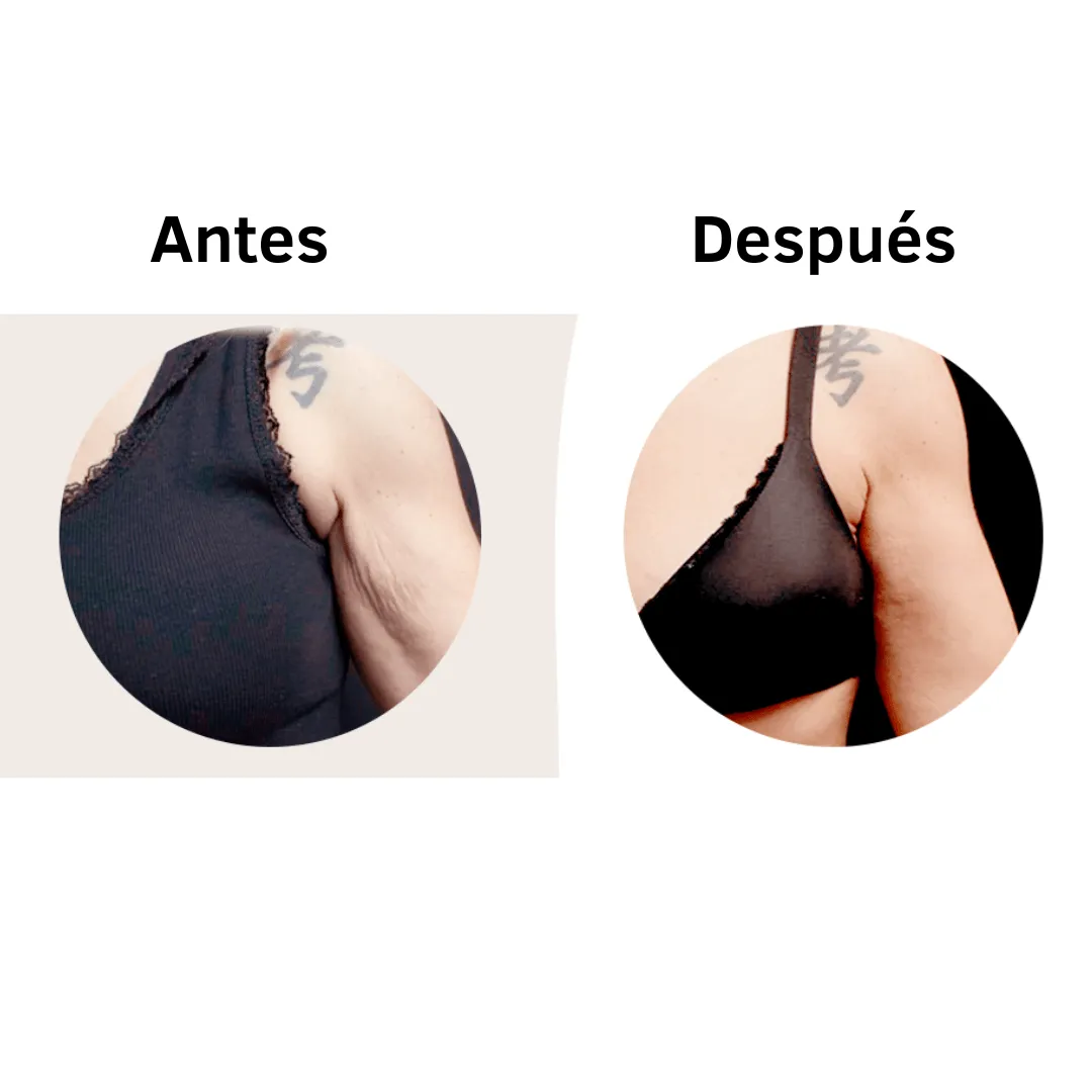 Antes y después tratamiento flacidez brazos.