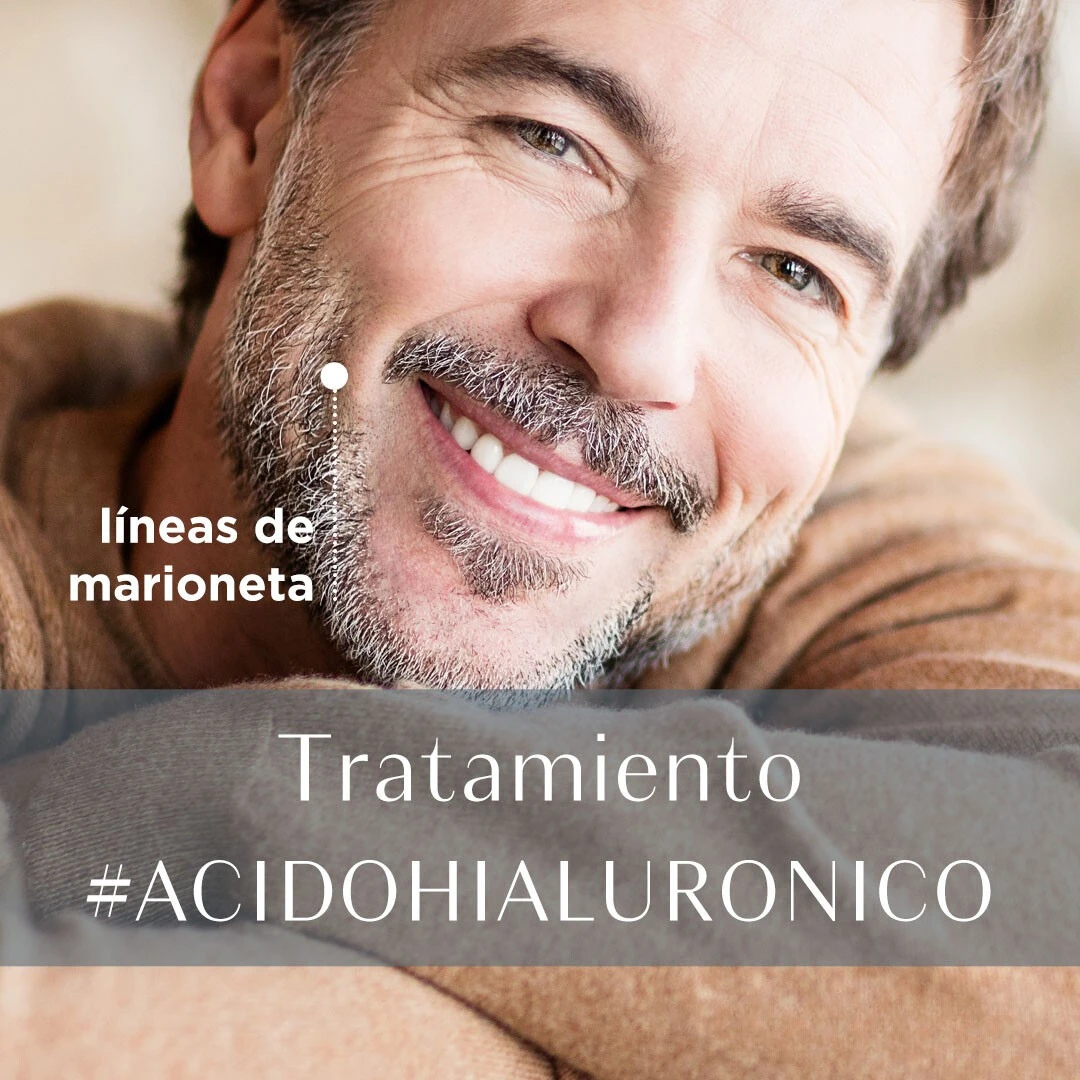 Despídete de las líneas de marioneta con nuestro tratamiento con ácido hialurónico.