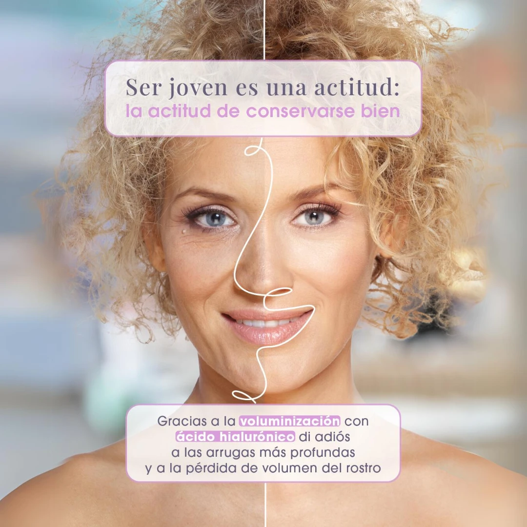 Con nuestro relleno de mandíbula con ácido hialurónico conseguimos rejuvenecer.