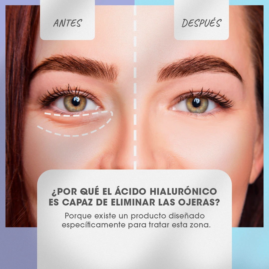 ¿Por qué el ácido hialurónico es capaz de eliminar las ojeras? Explicación del antes y después.