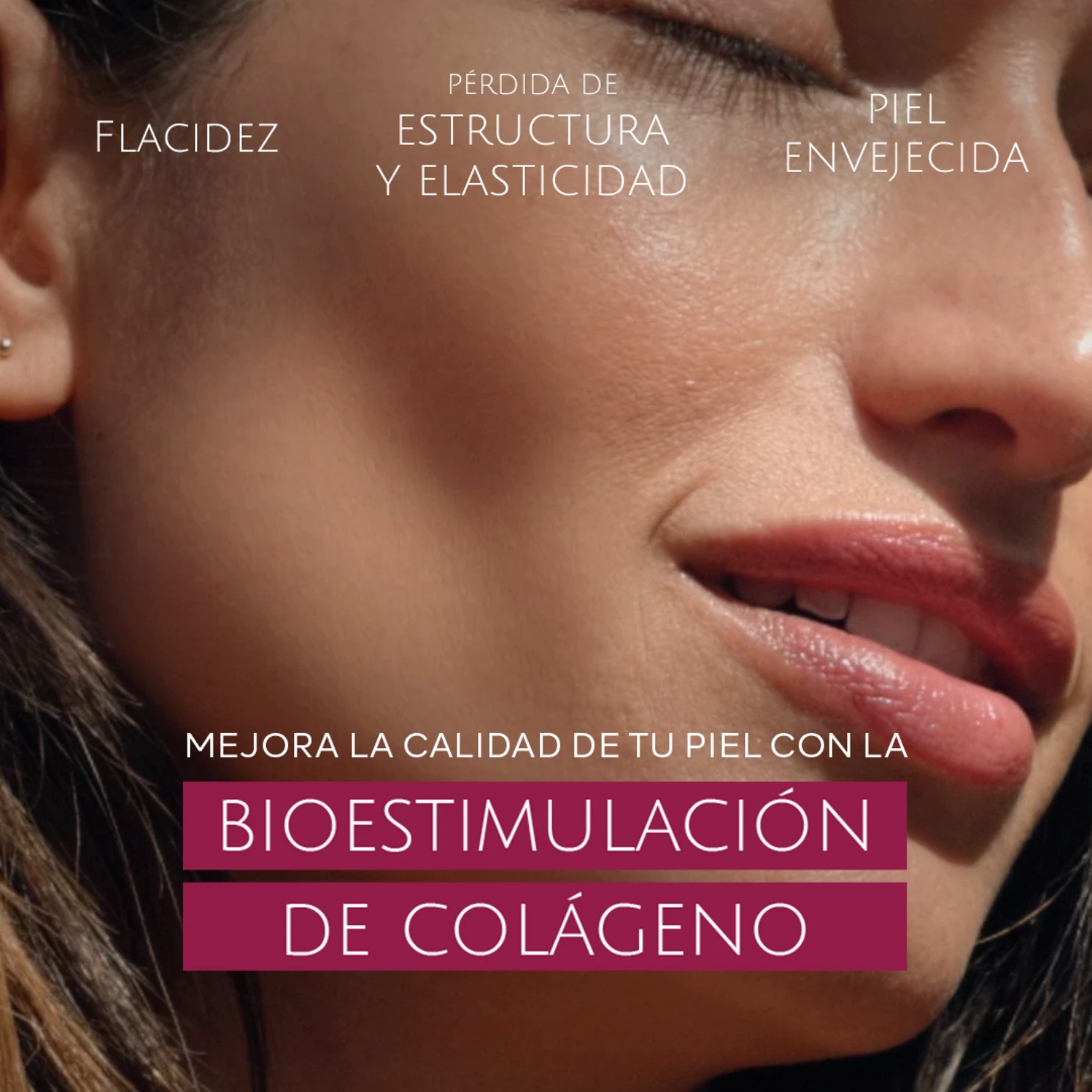 Bioestimulación de colágeno. Mejora la calidad tu piel: flacidez, pérdida de estructura y elasticidad, piel envejecida.