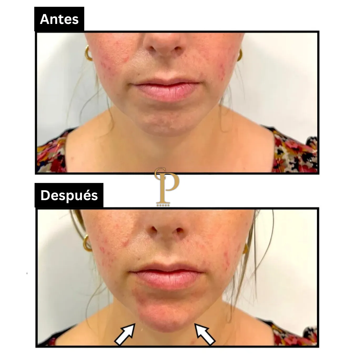 Antes y después del relleno de ácido hialurónico en mentón.