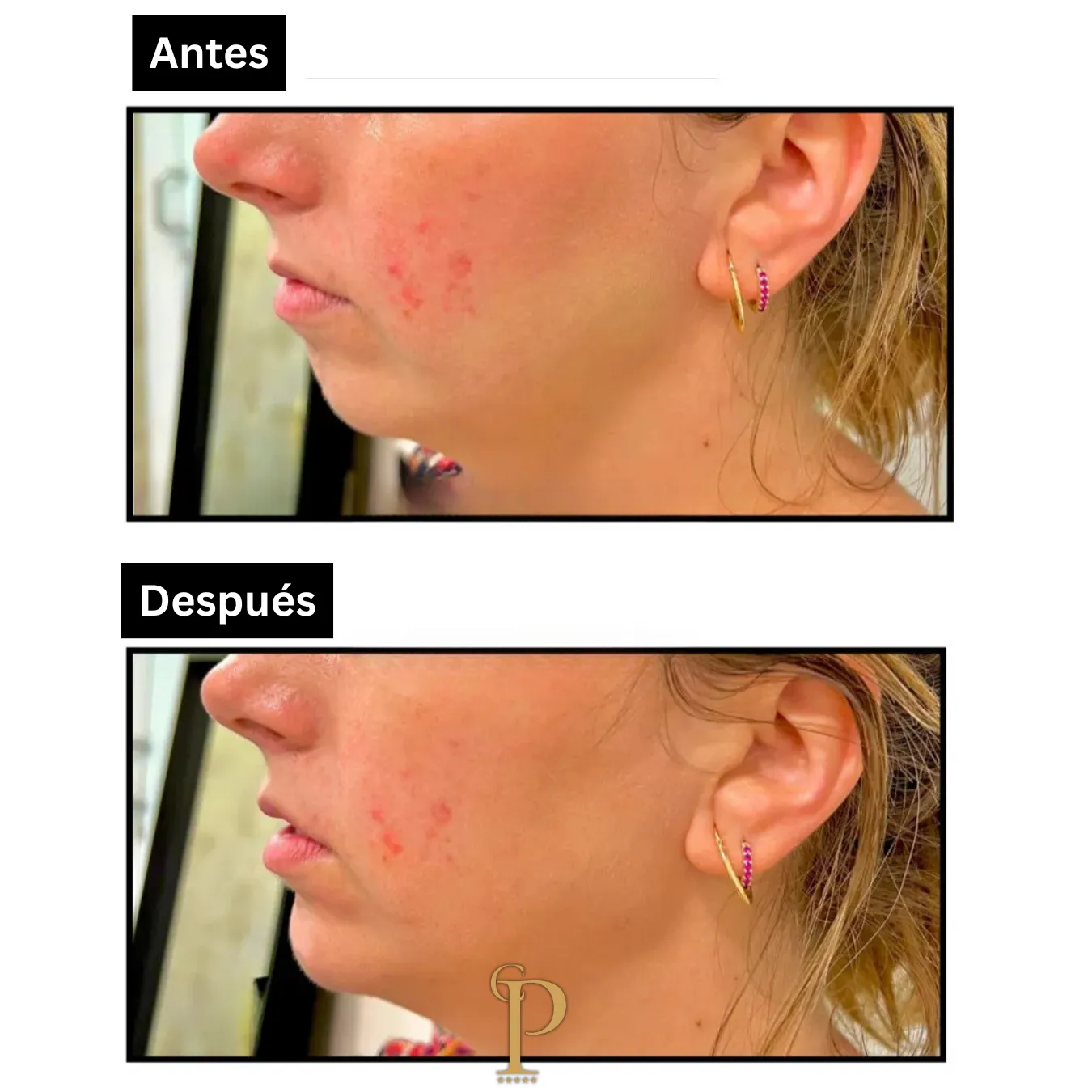 Antes y después del relleno de ácido hialurónico en mentón.