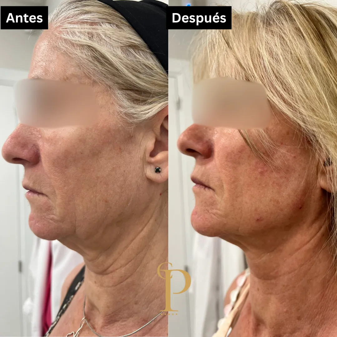 Antes y después tratamiento armonización facial.