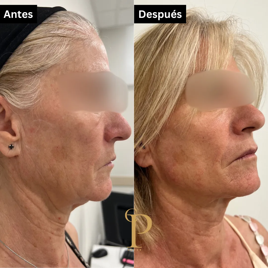Antes y después tratamiento armonización facial.