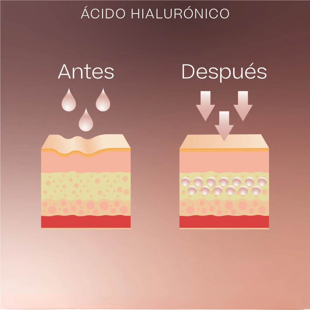 Imagen del efecto rellenador y de soporte del ácido hialurónico en la estructura del rostro.