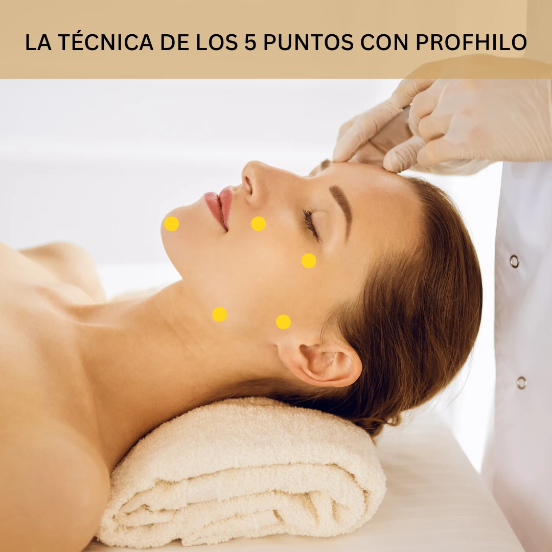 La técnica de los 5 puntos con Profhilo.
