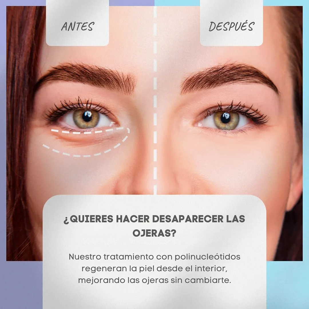 ¿Quieres hacer desaparecer las ojeras? Nuestro tratamiento con polinucleótidos regeneran la piel desde el interior, mejorando las ojeras sin cambiarte.